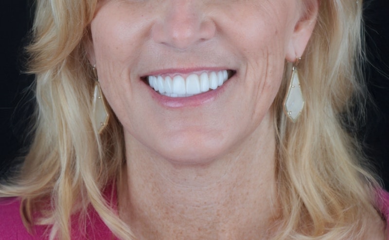 Laser contouring patient's results