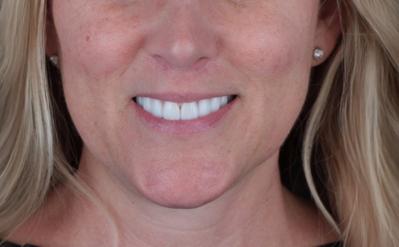 Veneers patient's smile