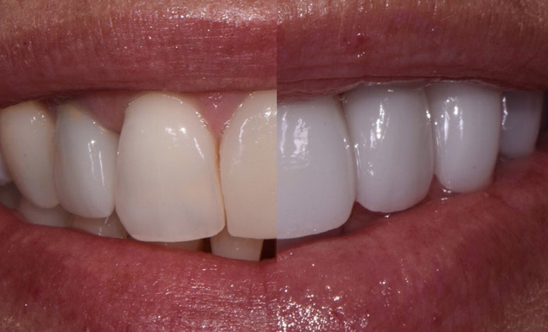 before and after teeth whitening