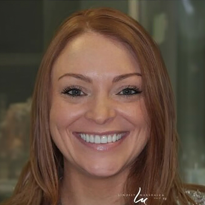 Patient after veneers