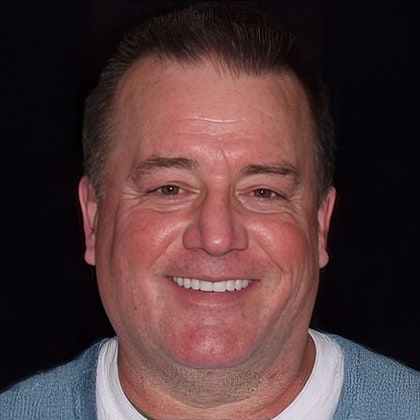 After Smile Makeover