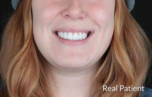 Beautiful woman after smile makeover