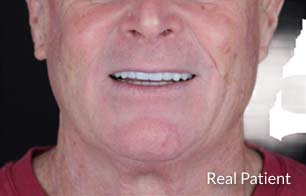 Smiling man after veneers treatment