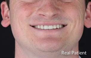 Invisalign tray over teeth