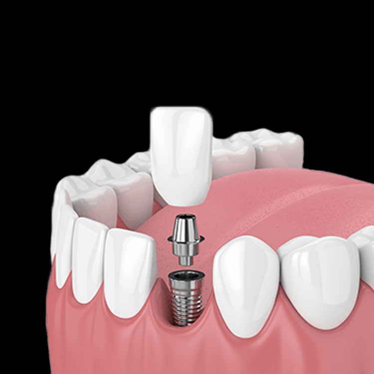 Implantes Dentales