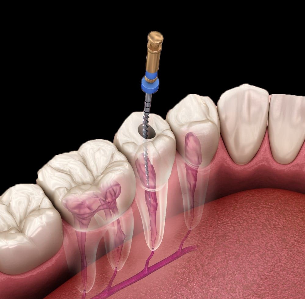 Endodoncias