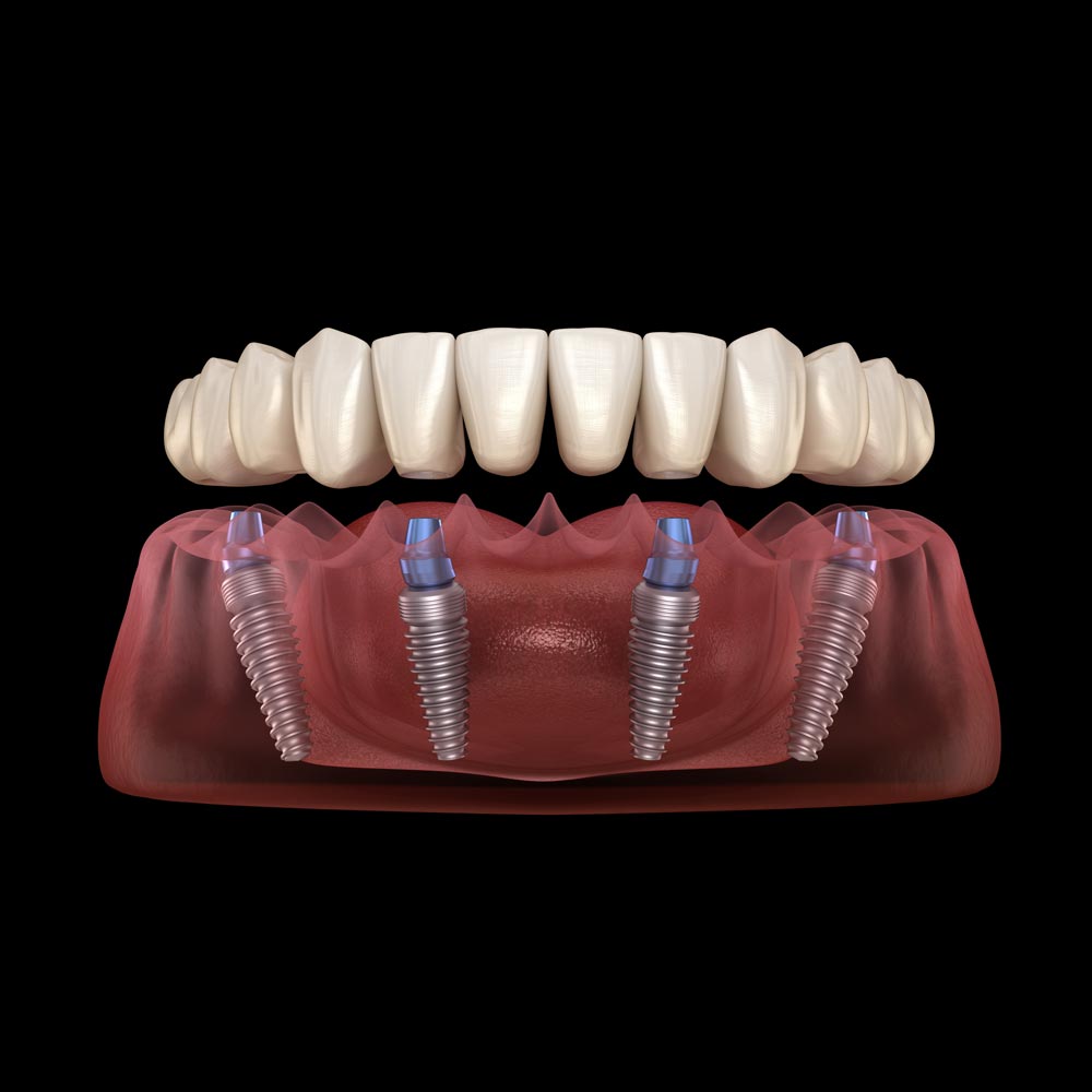 All-on-4 implant denture