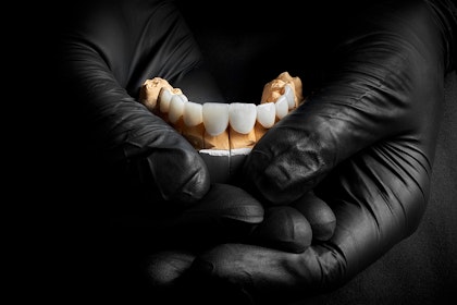 Dental model with veneers on it