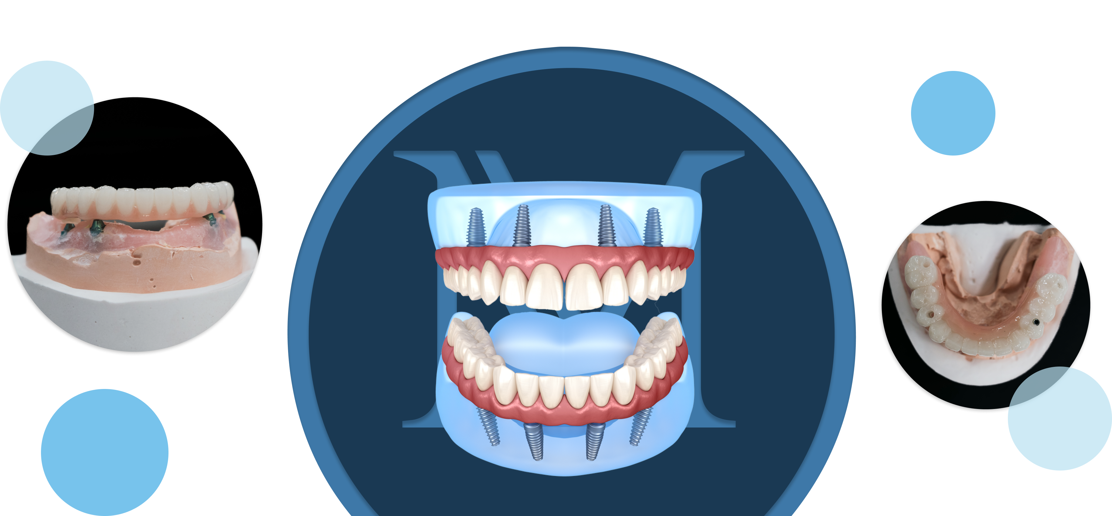 All-on-4 implants and denture plus office photos