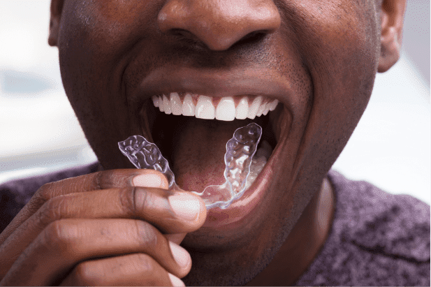 Man inserting Invisalign tray