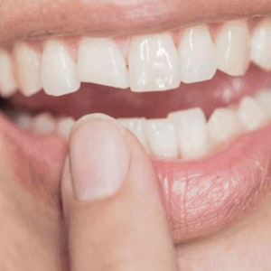 woman's smile with a chipped tooth