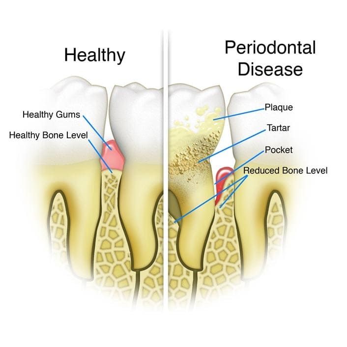 illustration showing periodontal disease