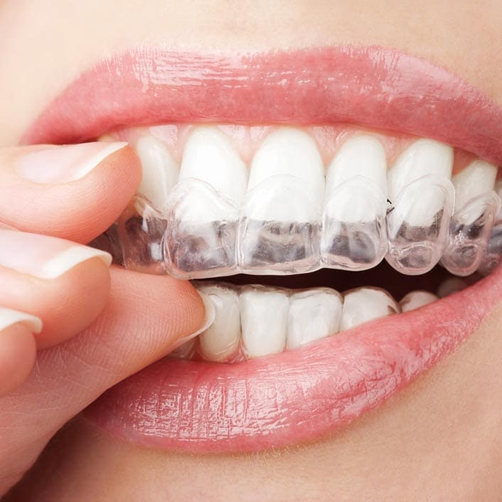 Invisalign tray being put on teeth