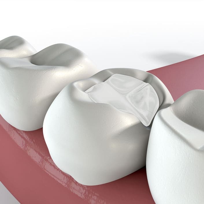 illustration of a filling in a tooth