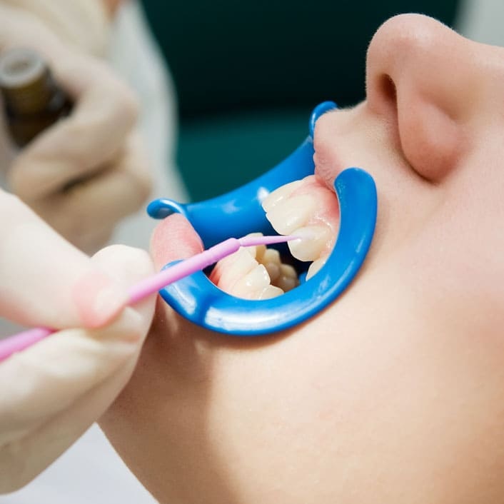 person getting dental bonding done