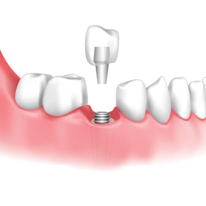 dental implant being placed