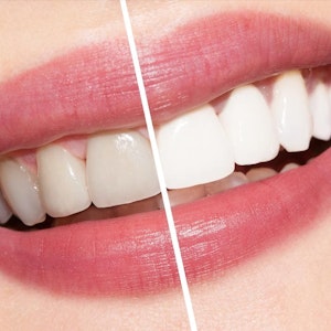 before and after teeth whitening