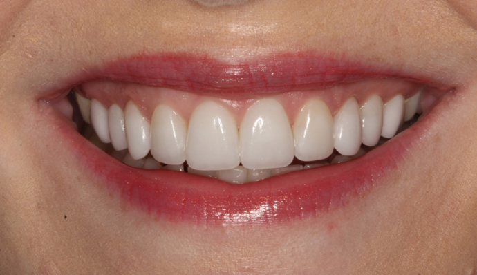 Dr. Allan Thomas' patient after veneers