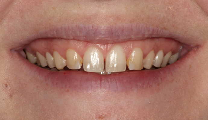 Dr. Allan Thomas' patient before veneers