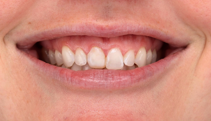 Dr. Allan Thomas' patient before veneers