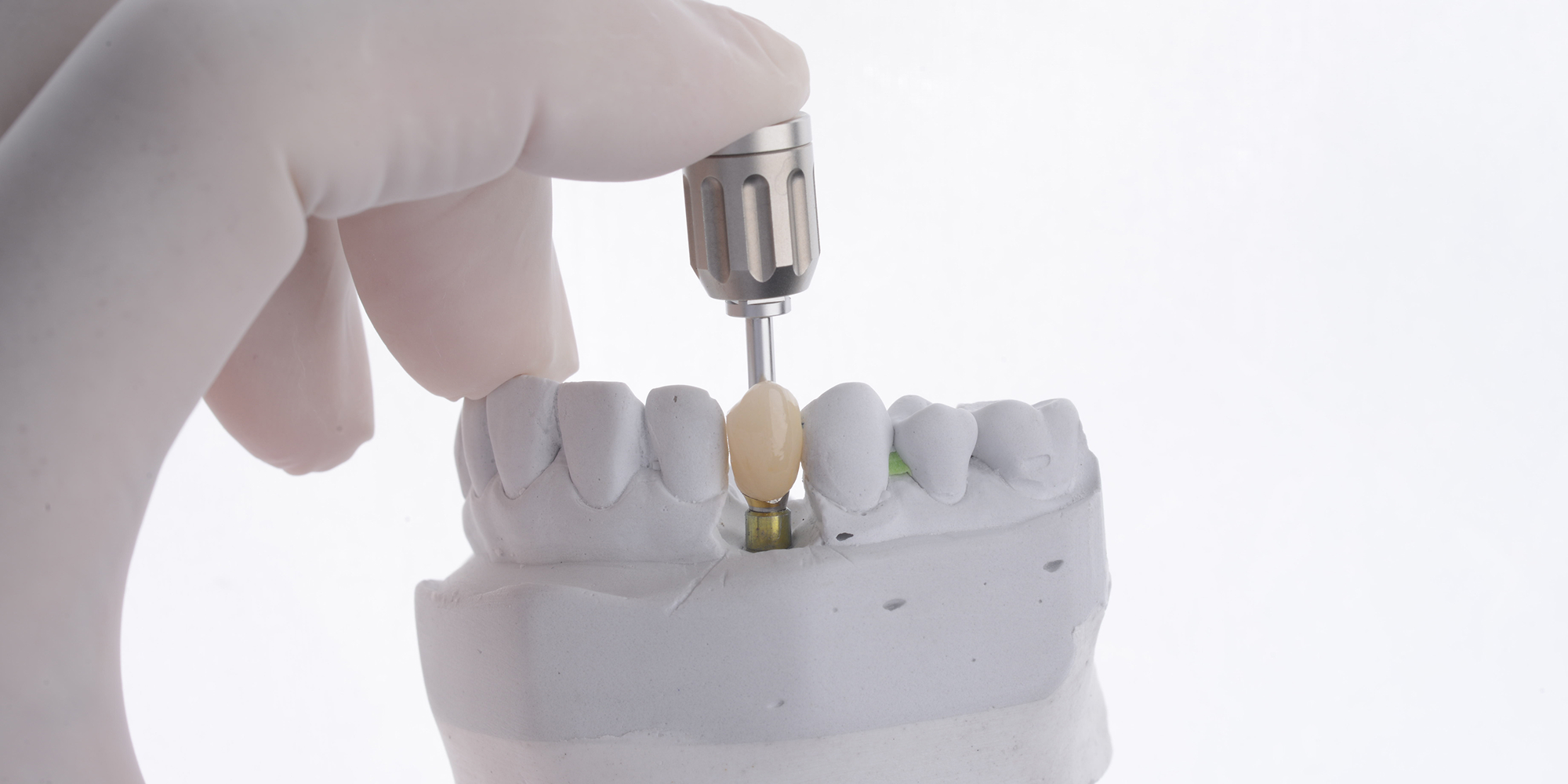 implant-supported crown