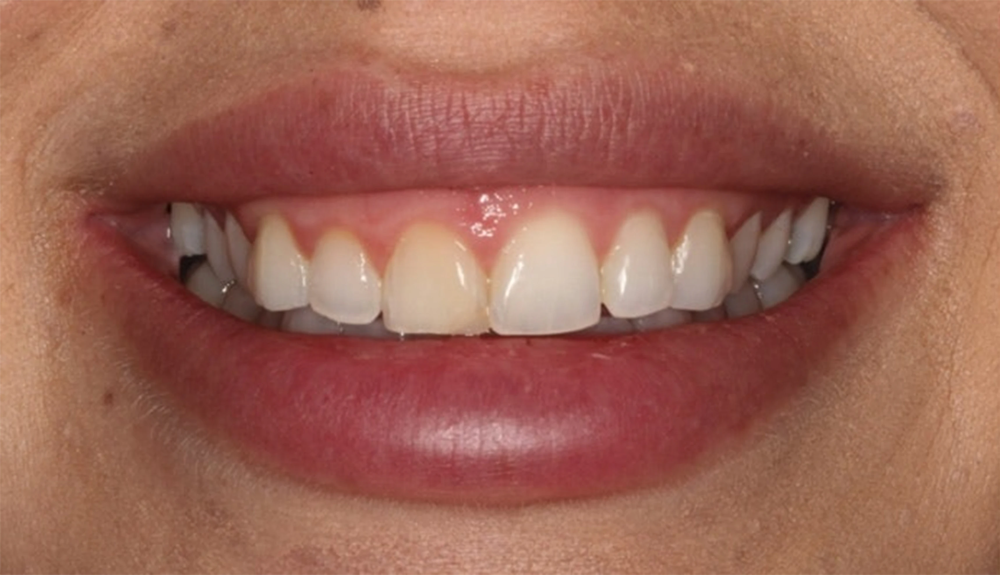 before cosmetic dentistry