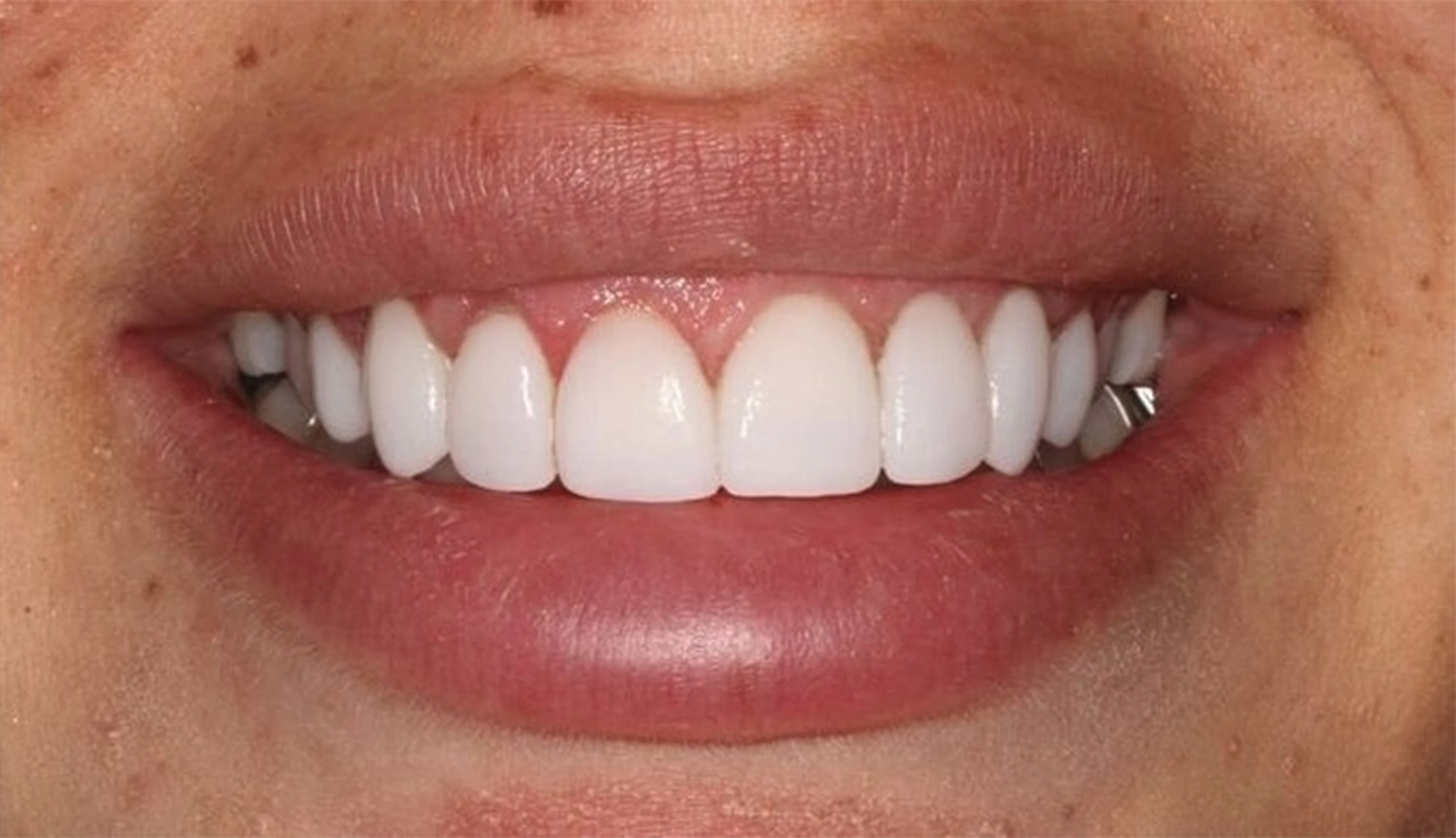 after cosmetic dentistry