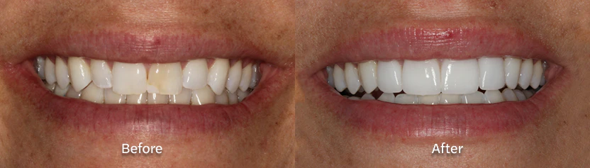 before and after cosmetic dentistry