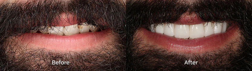before and after dental implants