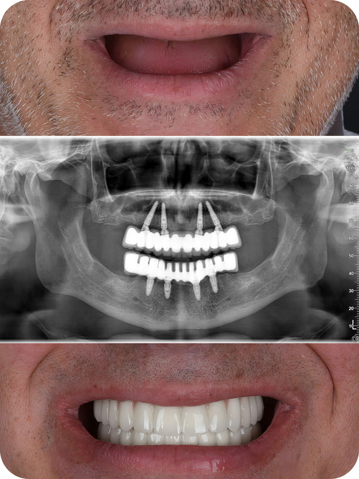 collage of smiling all on four patient