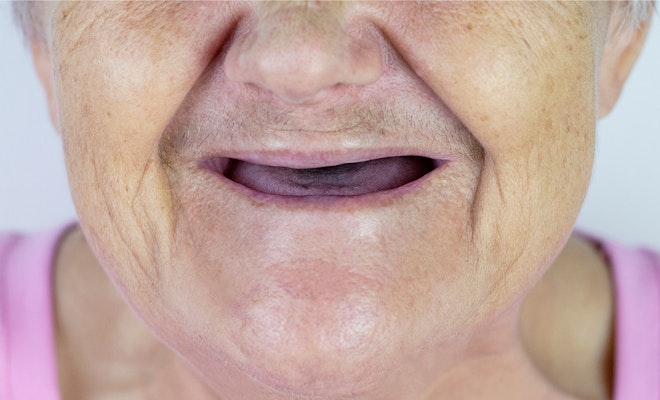 Senior woman with a mouth of missing teeth