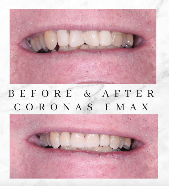 patient before and after e.max crowns