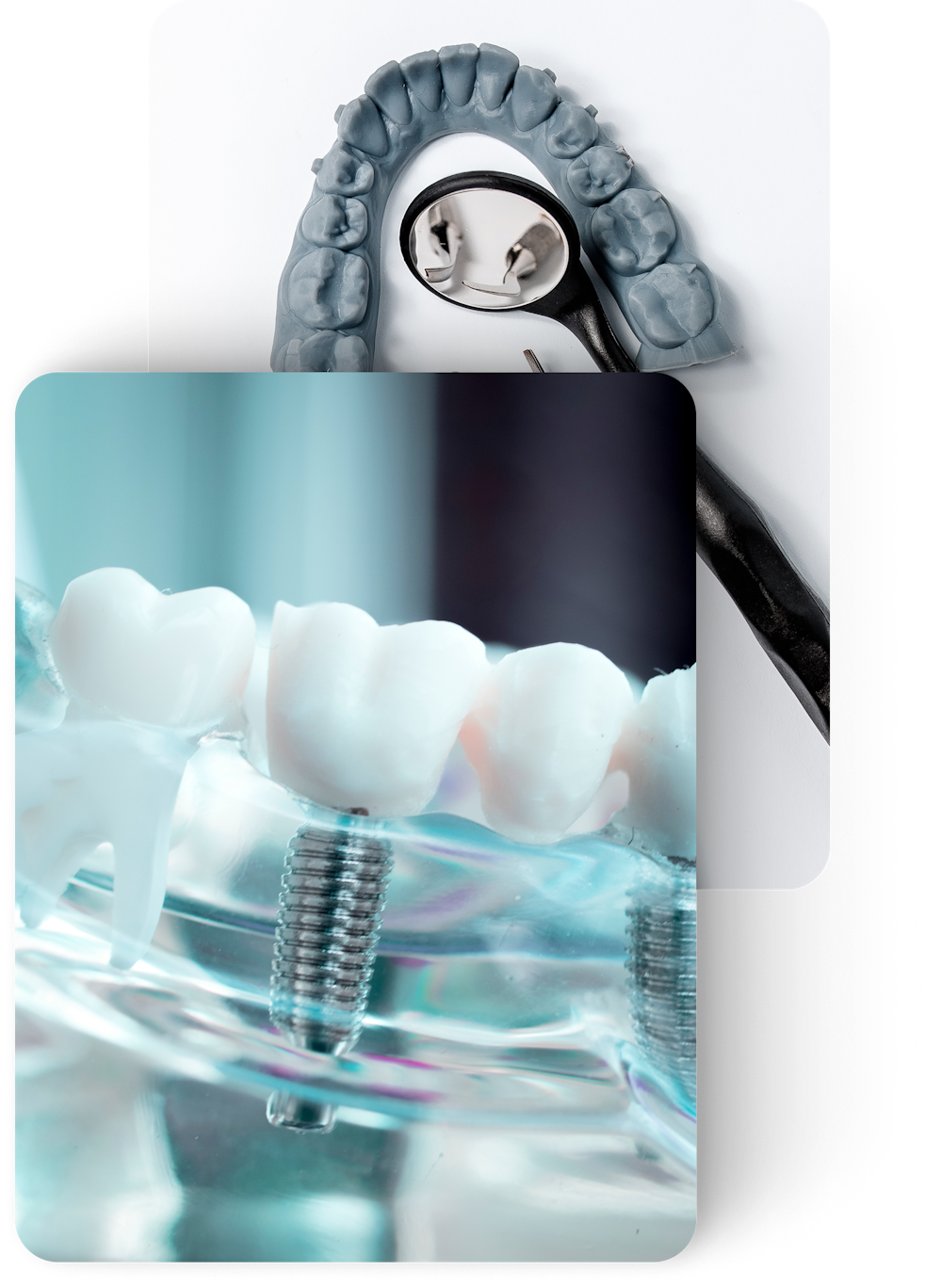 Dental implant model