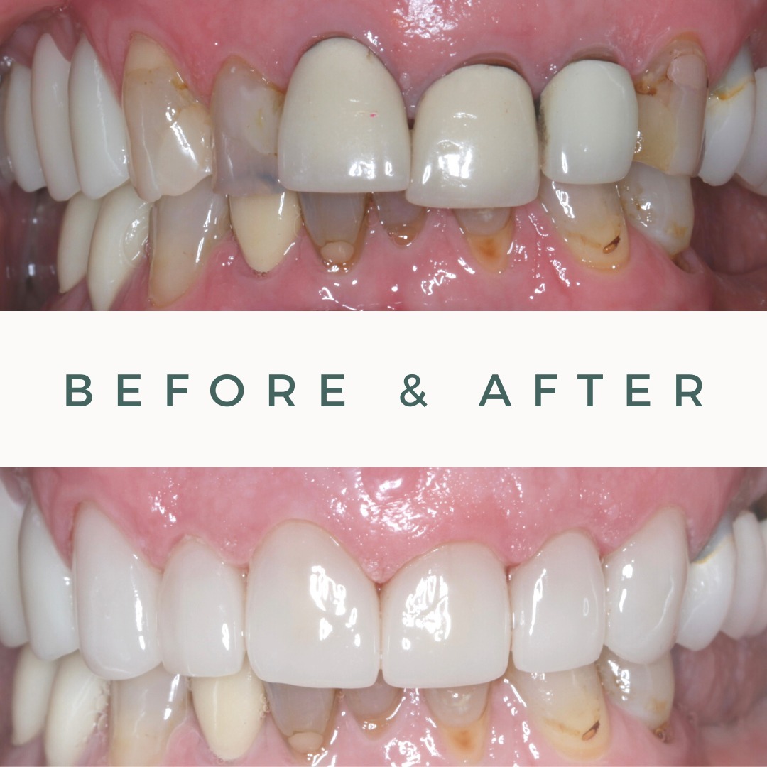 Before-and-after dental photos showing stained, uneven front teeth compared to a brighter, more uniform smile after treatment.