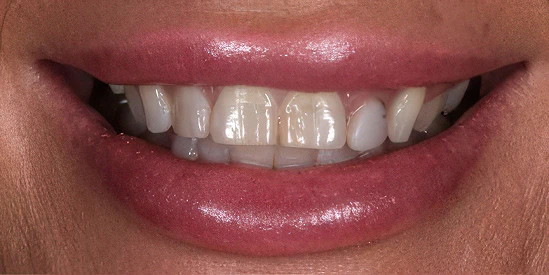 Before veneers