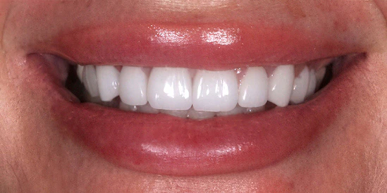 After veneers