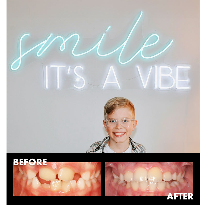 Hank — Phase 1 braces complete at Avenue South Orthodontics