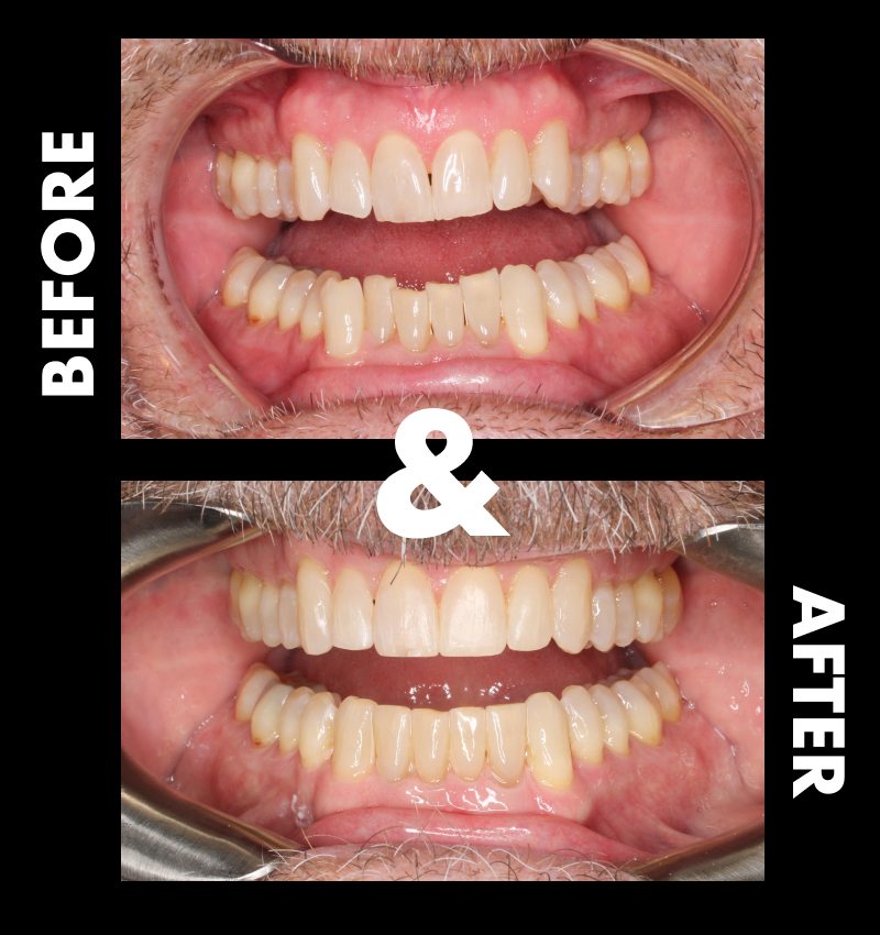 Nashville patient before and after Invisalign treatment