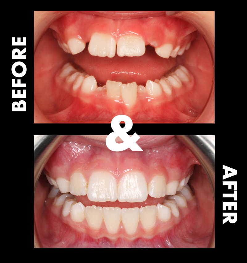 Nashville patient before and after Invisalign treatment