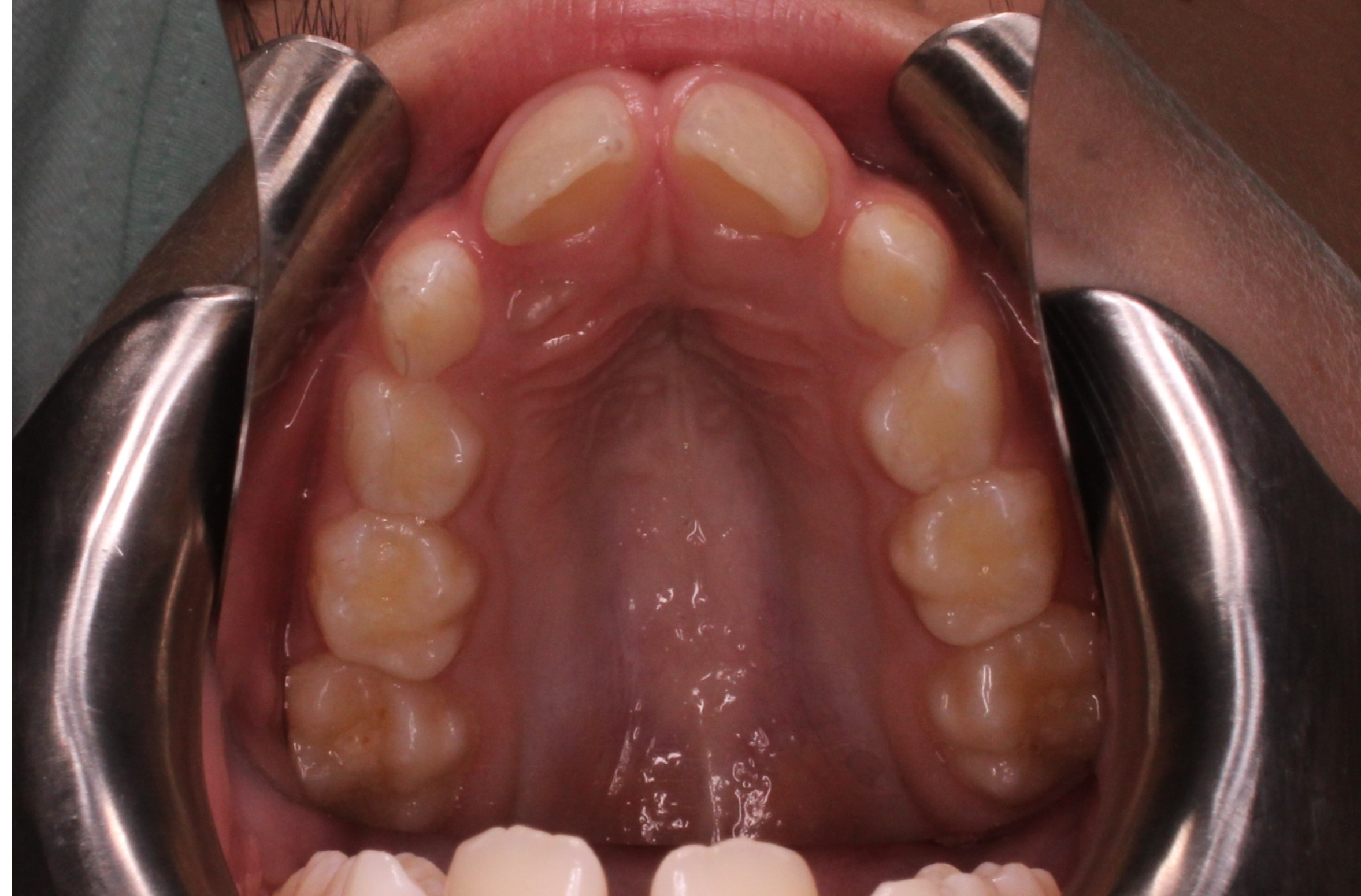 Occlusal Upper Before