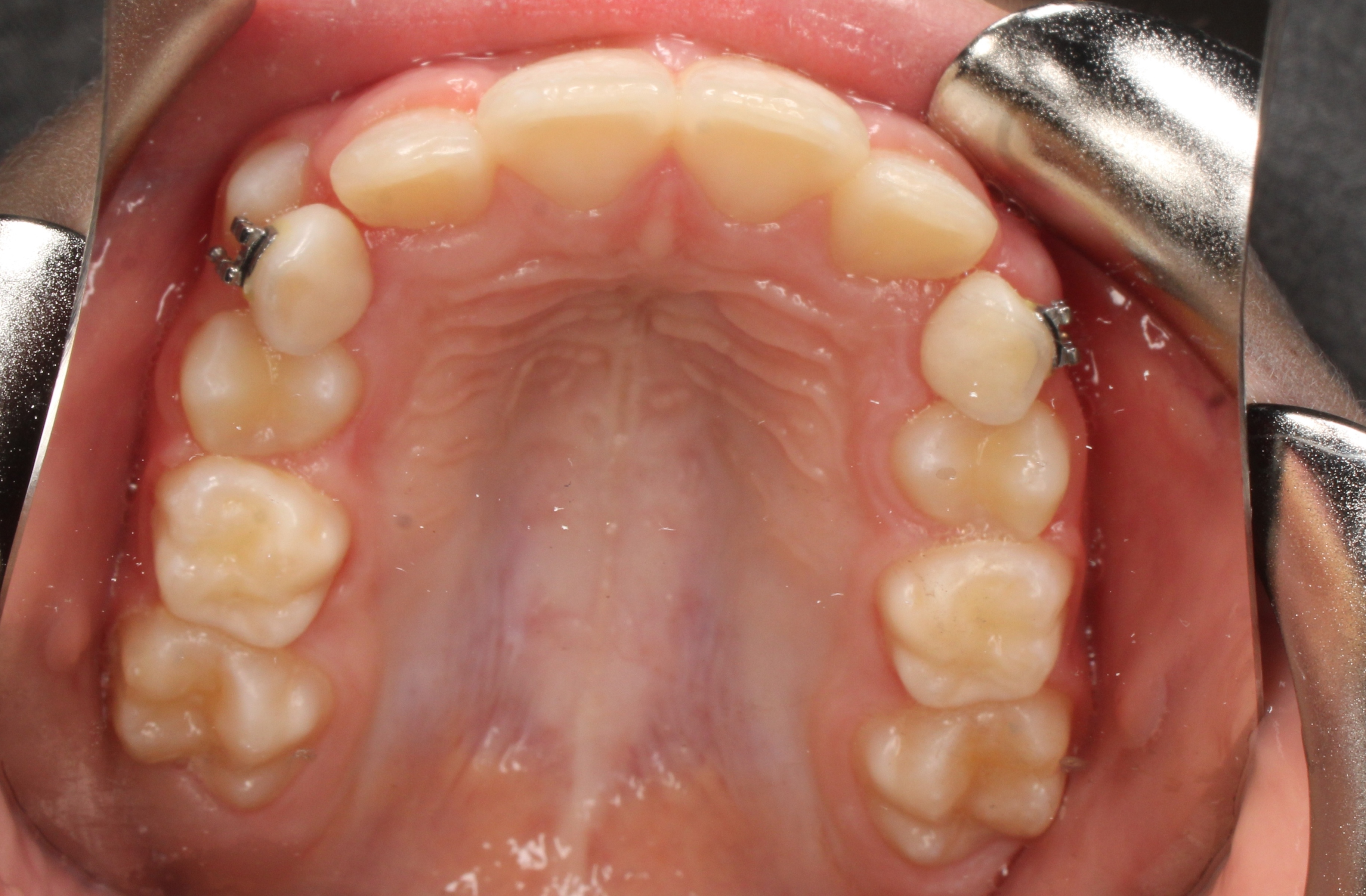 Occlusal Upper After