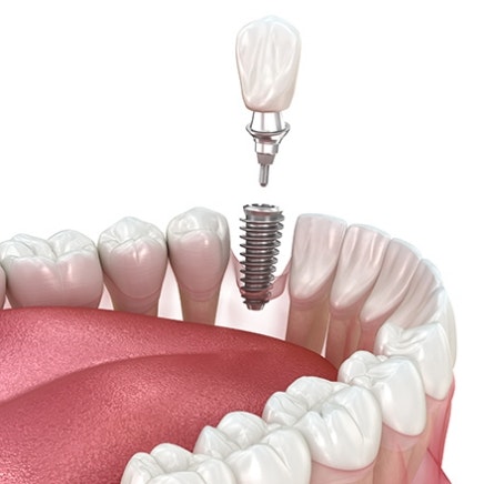 Implant crown