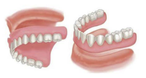 Full dentures