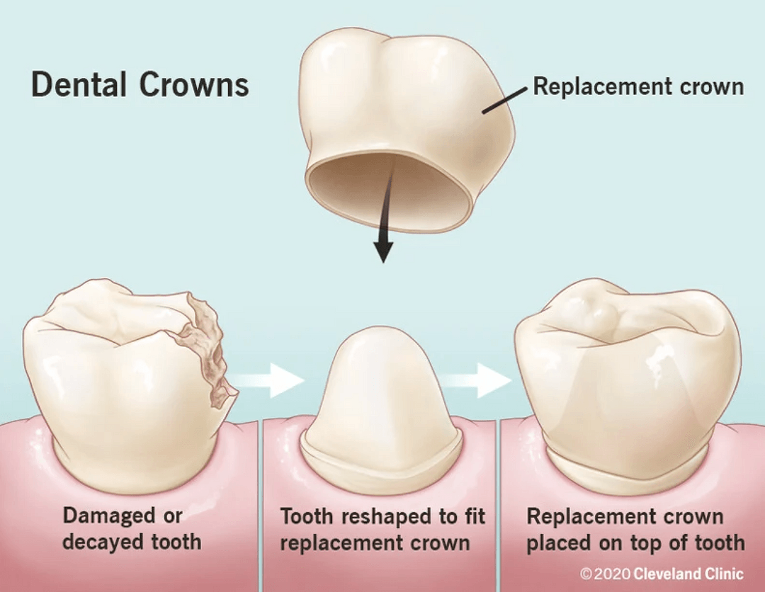 Dental crown repair