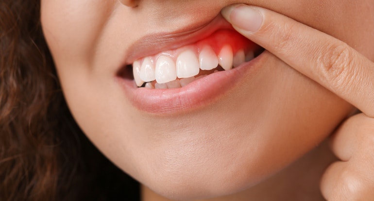 Woman with gum disease