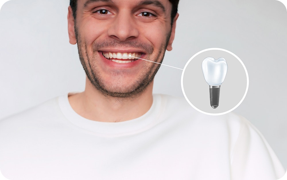 Smiling man with implant graphic