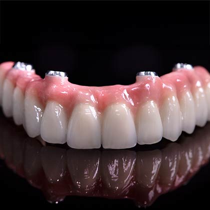 implant dentures