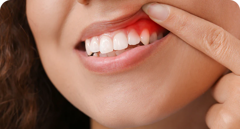 inflamed gums