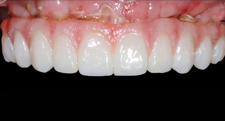 all-on-4 dentures