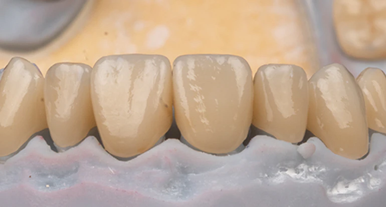 dental crowns
